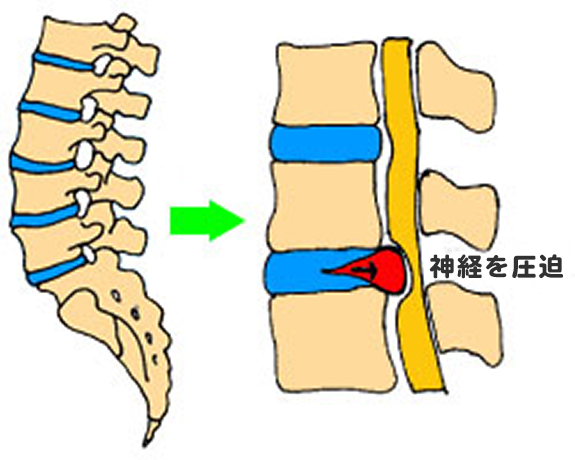 腰椎椎間板ヘルニアの原因と病態