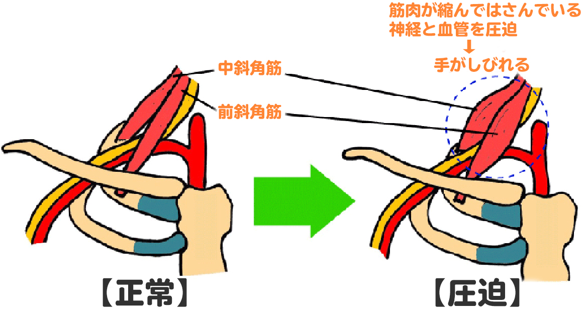 斜角筋症候群