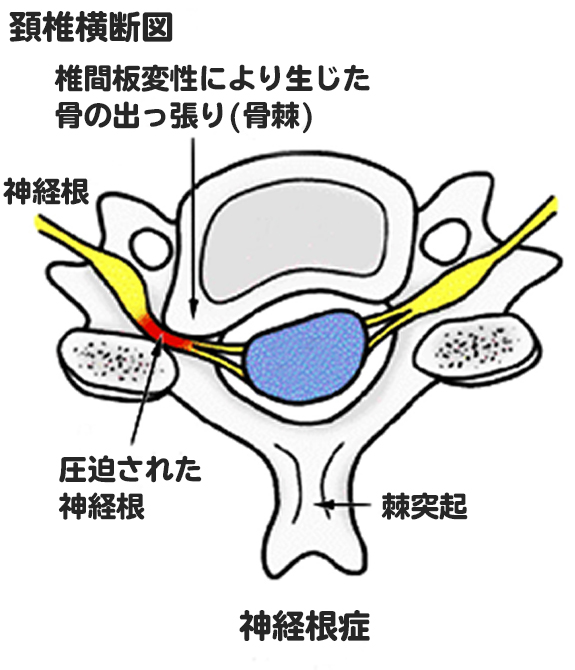 頚椎症性神経根症