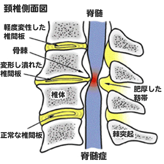 頚椎症性脊髄症