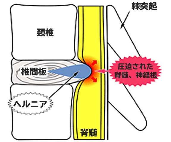 頚椎椎間板ヘルニア